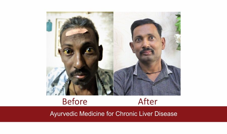 Ayurvedic Medicines For Liver Disease