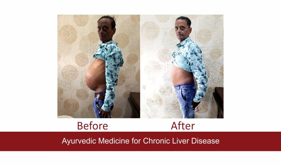 Ayurvedic Medicines For Liver Disease