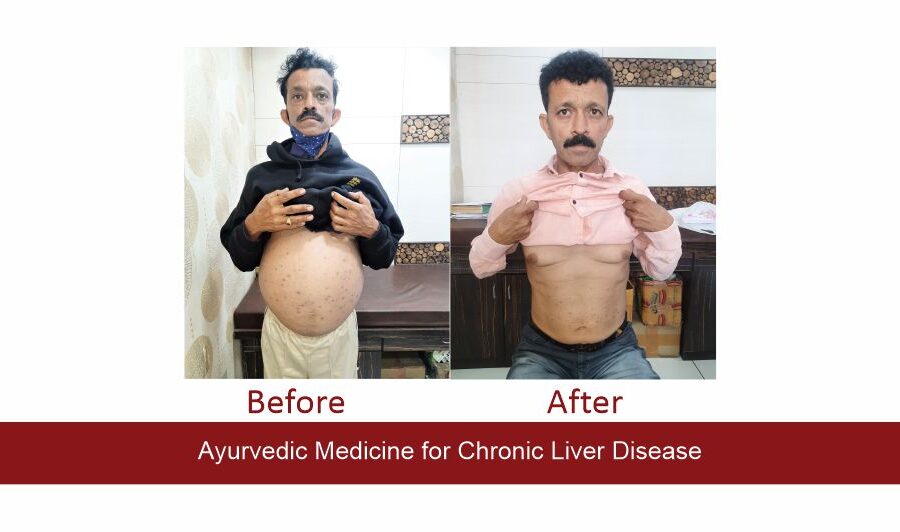 Amit Upadhyay - Liver Cirrhosis Treatment