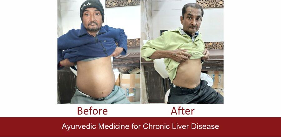 Jigneshbhai liver cirrhosis